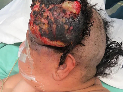 Multiple myeloma of the scalp