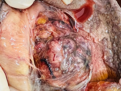 Autopsy, necrotic tissue